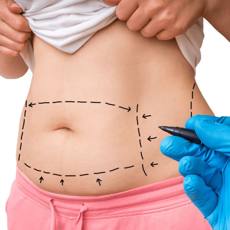 Tummy Tuck Tummy Tuck image